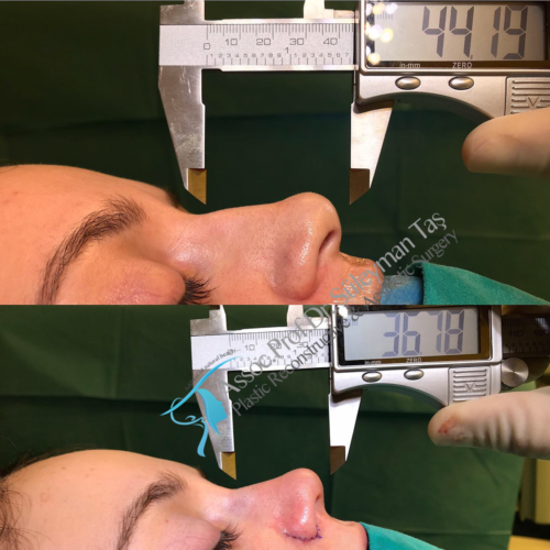 Bulbous Nasal Tip 7