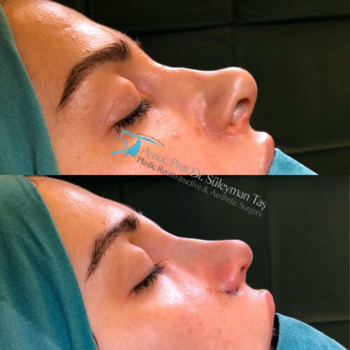 Thick Skin Septorhinoplasty
