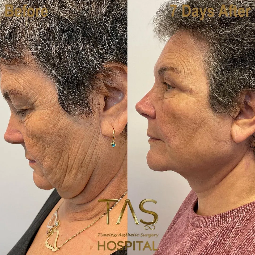 Case Study Number 19 - Expert facelift for aged skin