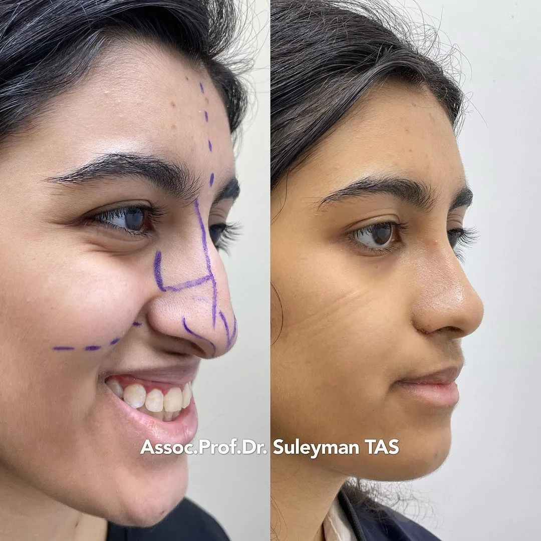 Case Study Number 16 - Nose enhancement
