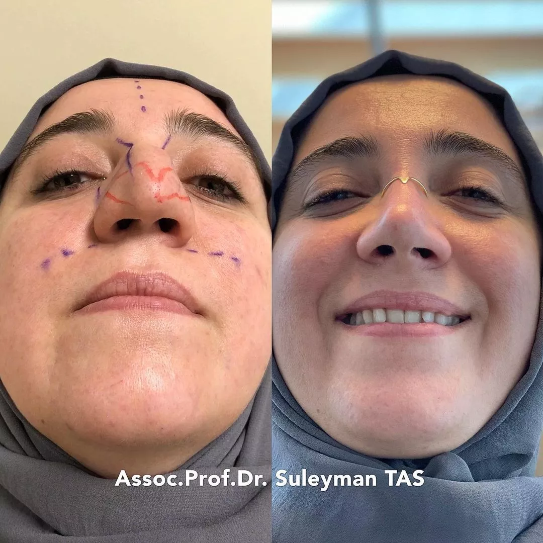 Case Study Number 11 - Septo Rhinoplasty