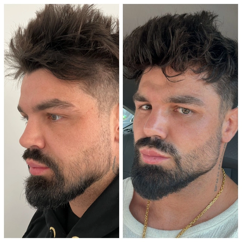 Celebrity plastic surgery by Dr Suleyman Tas