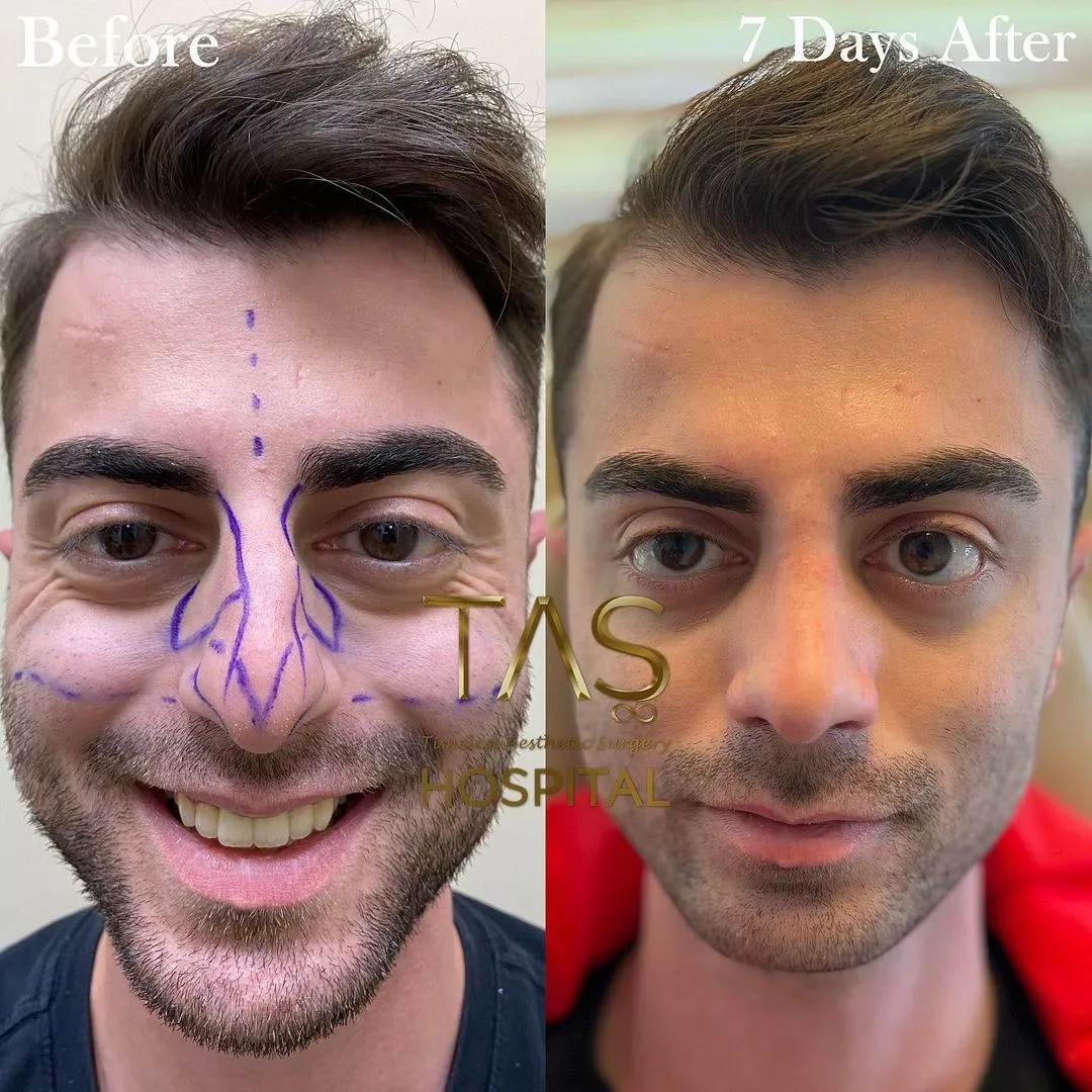 Case Study Number 17 - Male Nose Reshaping