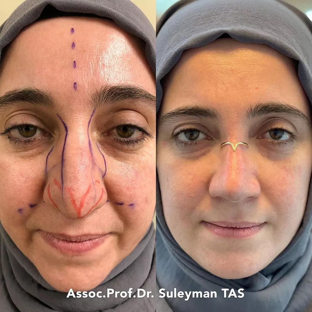Rhinoplasty case study by Dr. Tas