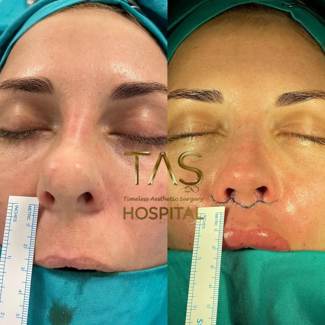 Case Study Number 22 - Lip Lift