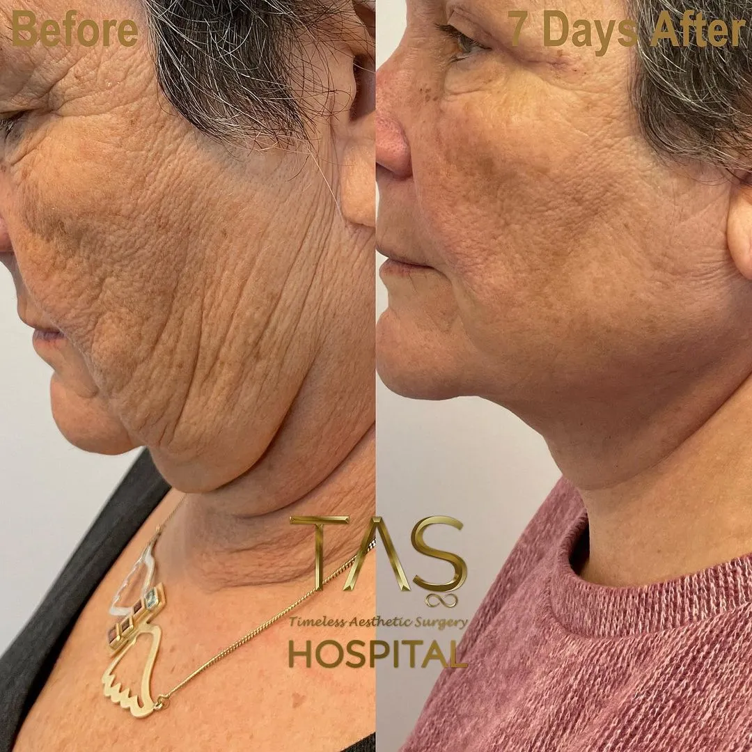Case Study Number 19 - Expert facelift for aged skin