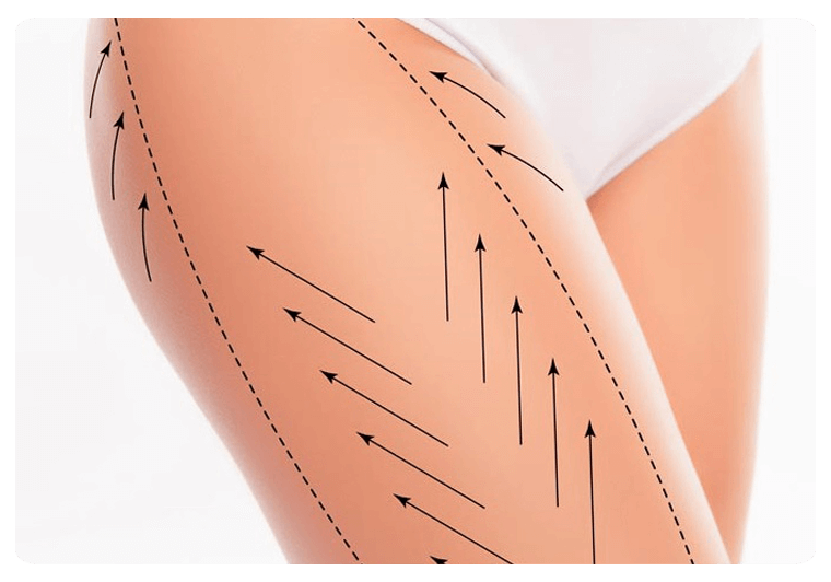 Types of Thighplasty