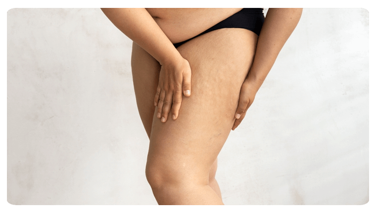 Cost of Thigh Lift in istanbul
