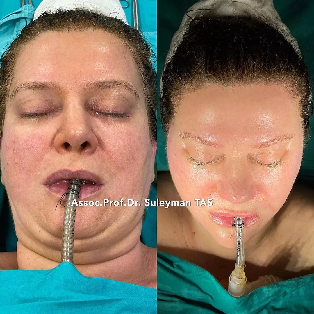 Case Study Number 5 - Facial Cosmetic Surgery