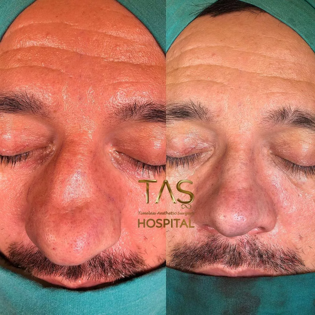 Case Study Number 7 - Bulbous nose rhinoplasty