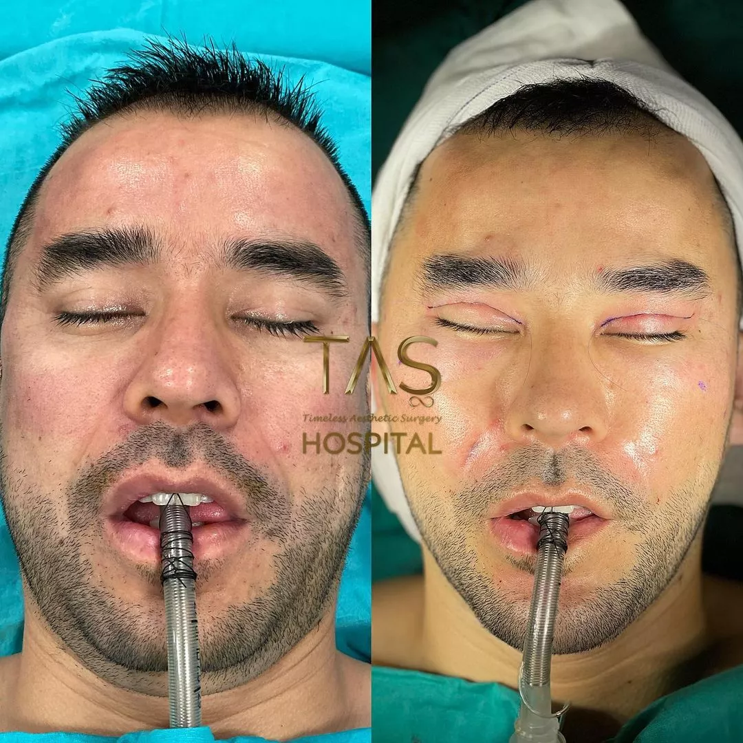 Case Study Number 10 - Male Facial enhancements