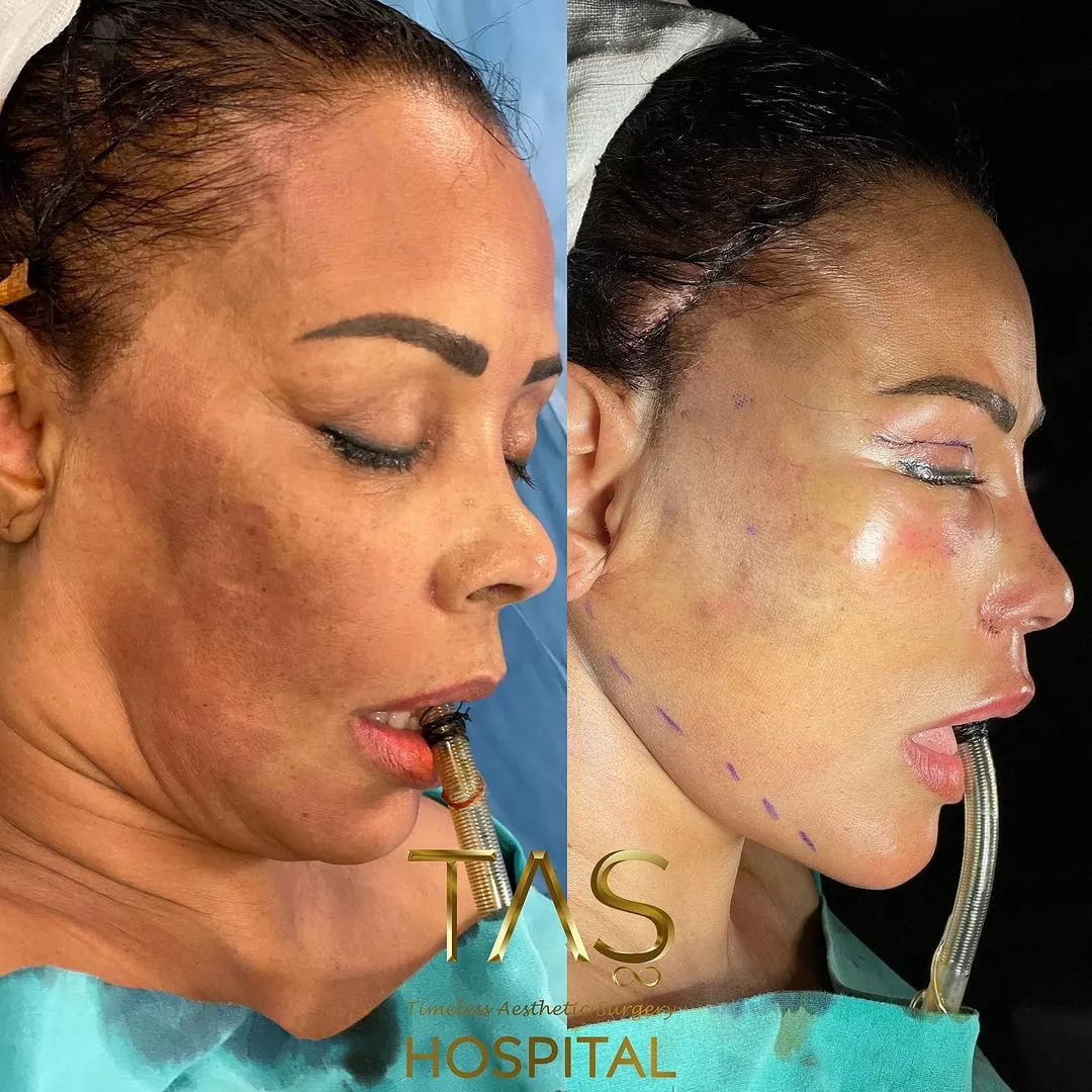 Case Study Number 8 - Facial Plastic Surgery