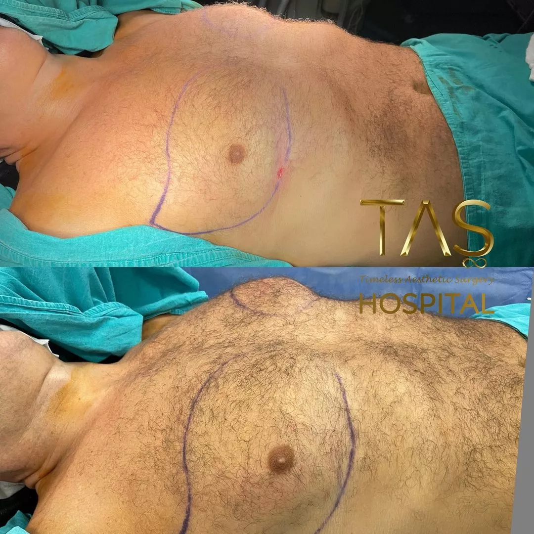 Case Study Number 23 - Gynecomastia